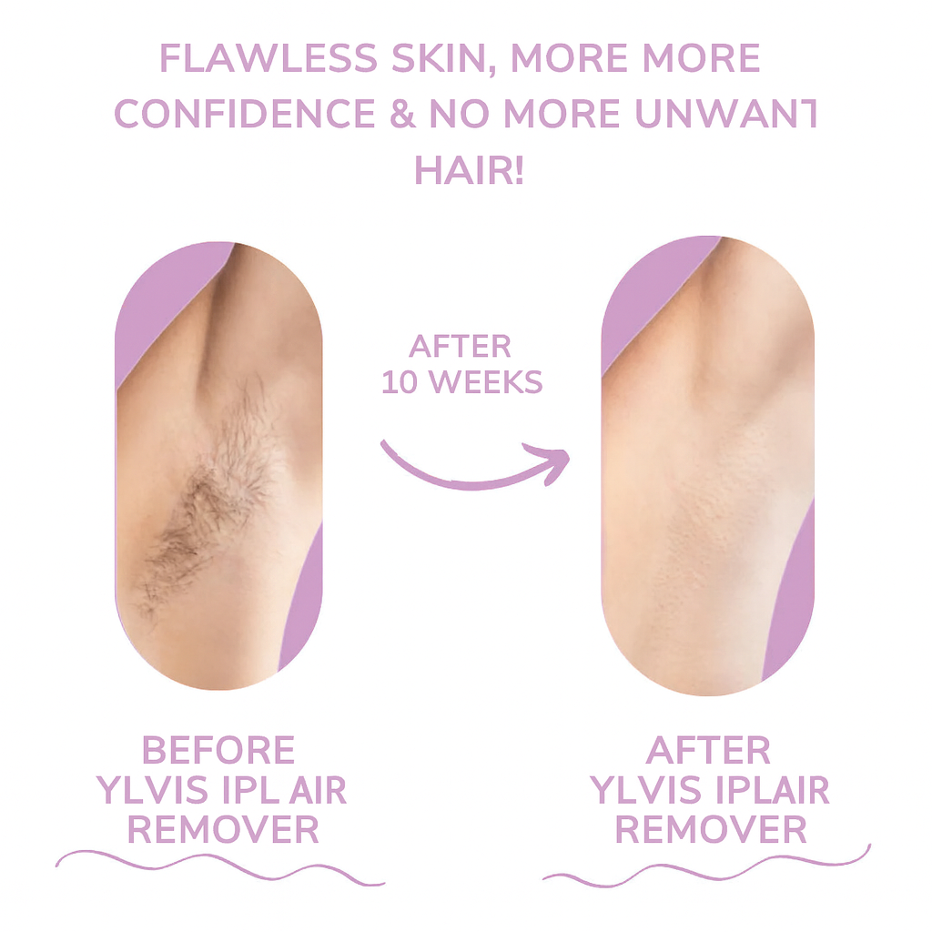 ✨ Ylvis IPL Hair Remover – Smooth, Hair-Free Skin from Home