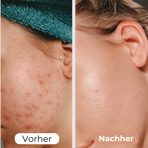 WrinkleAway™ Hydrated Wrinkle Reduction